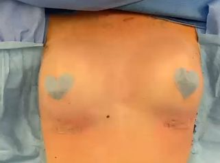 Brustvergrößerung bei Asymmetrie – Ausgleich mit unterschiedlich großen Implantaten