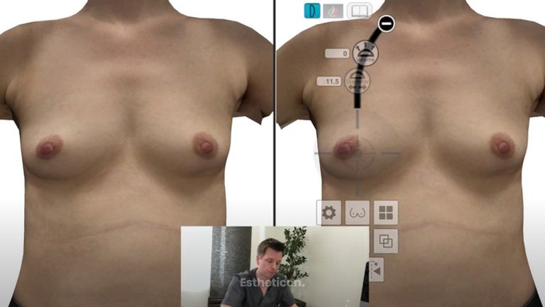 3D Simulation zur Brustvergrößerung mit Crisalix und Motiva Ergonomix Implantaten