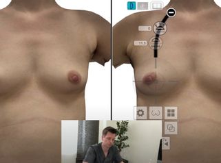 3D Simulation zur Brustvergrößerung mit Crisalix und Motiva Ergonomix Implantaten