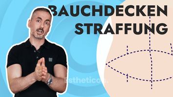 Dein Plastic Surgery Coach - Labbrige Bauchdecke? Alles über die Bauchdeckenstraffung.